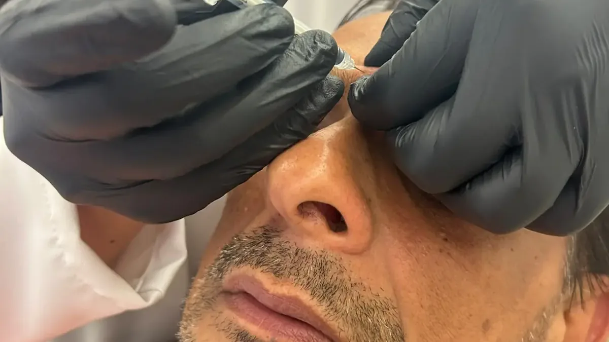 Botox preventivo funciona? Quando começar a prevenir rugas