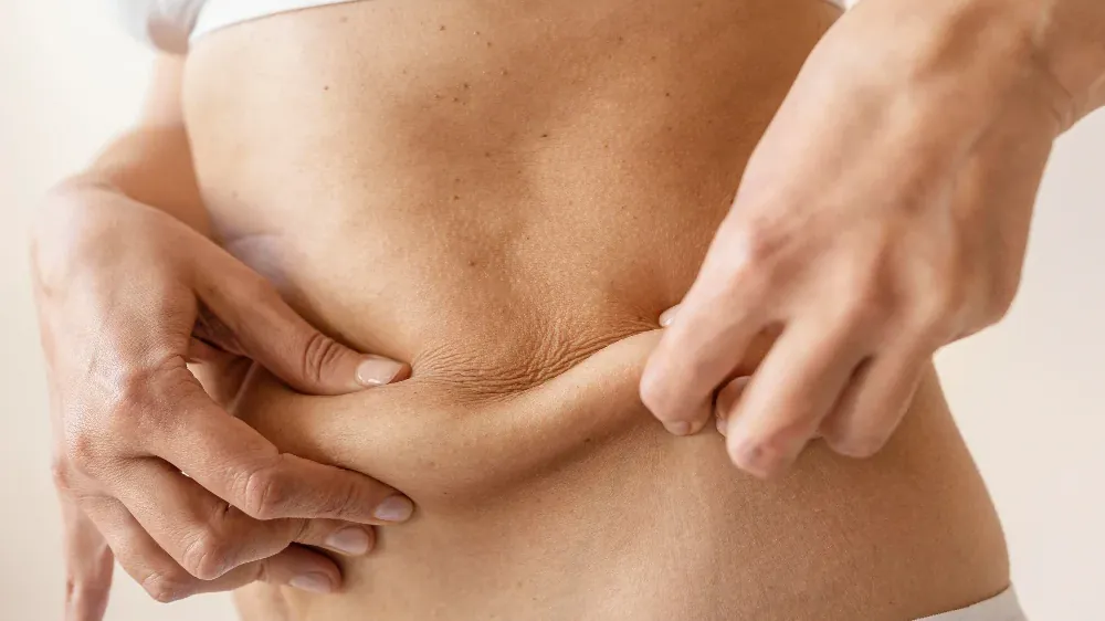 Flacidez corporal: por que acontece e até onde a estética ajuda