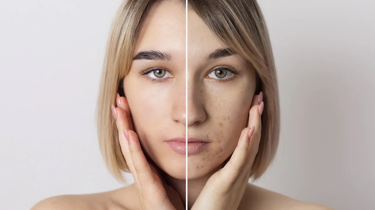 Marcas de acne na fase adulta: o que trata mancha e o que trata cicatriz
