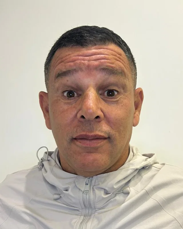 Homem de meia-idade fotografado de frente, antes e depois da aplicação de toxina botulínica na testa — antes