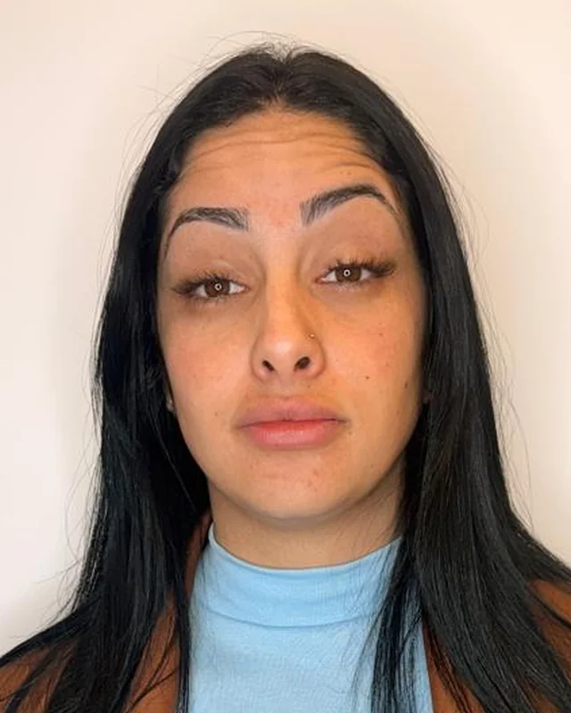 Mulher de cabelos longos escuros fotografada de frente, antes e depois da aplicação de toxina botulínica na testa — antes