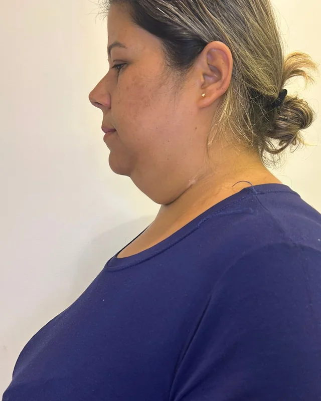 Perfil do contorno do queixo e do pescoço de uma paciente, antes e depois da lipoenzimática de papada — antes