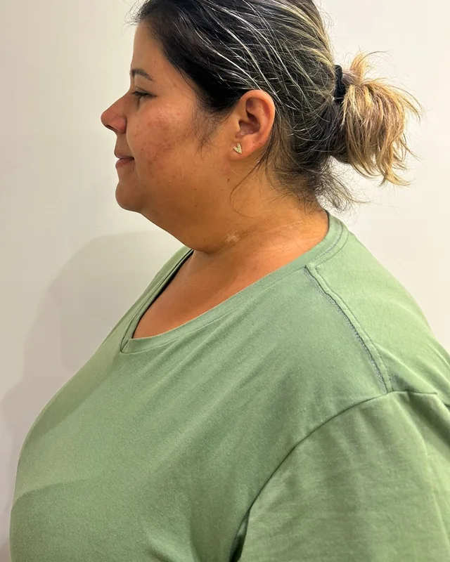 Perfil do contorno do queixo e do pescoço de uma paciente, antes e depois da lipoenzimática de papada — depois