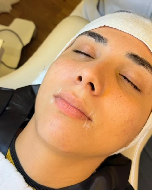 Lábios de uma paciente deitada na maca, antes e depois do preenchimento com ácido hialurônico — antes