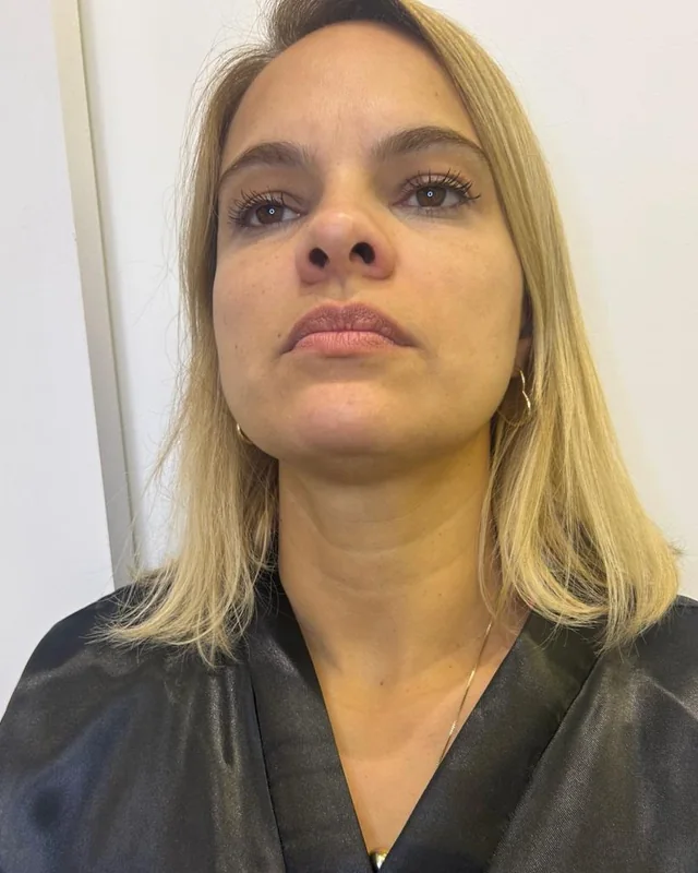Rosto de uma paciente de frente, antes e depois do preenchimento labial com ácido hialurônico — antes