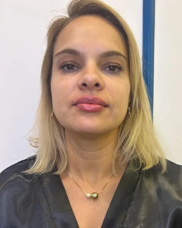 Rosto de uma paciente de frente, antes e depois do preenchimento labial com ácido hialurônico — depois