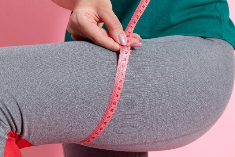 Lipedema: o que é, sintomas e como tratar essa condição pouco conhecida