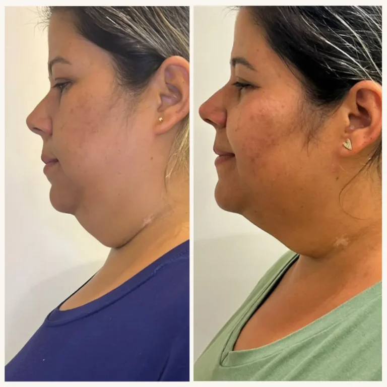 Antes e depois de uma mulher que realizou procedimento de aplicação de enzimas para diminuir a papada